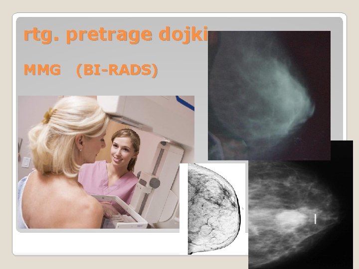rtg. pretrage dojki MMG (BI-RADS) rtg. pretrage dojki MMG (BI-RADS)