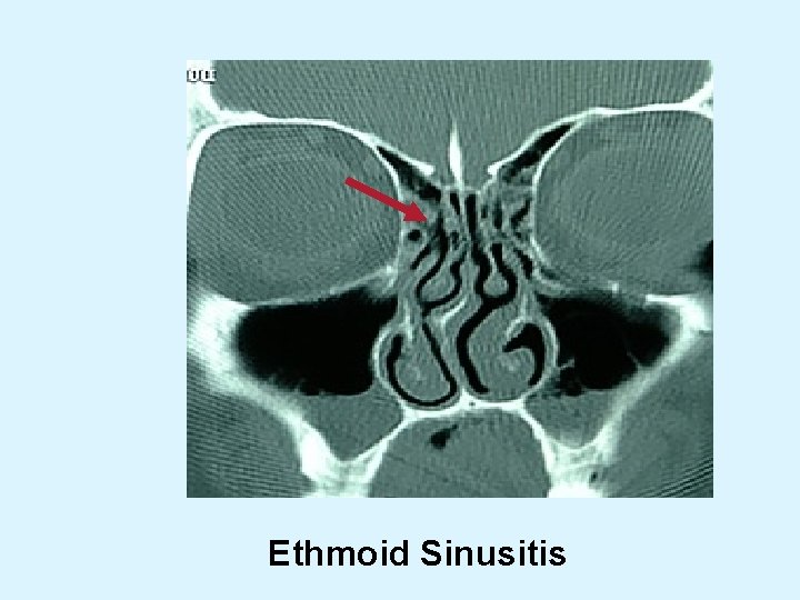 Ethmoid Sinusitis 