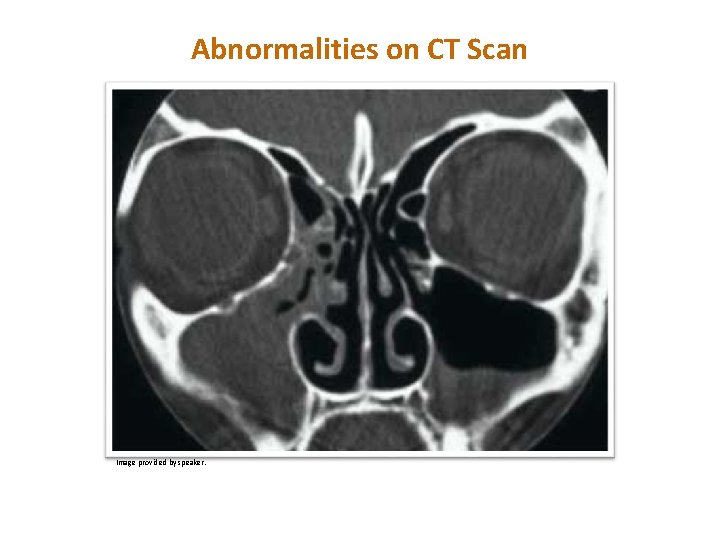 TM Abnormalities on CT Scan Image provided by speaker. 