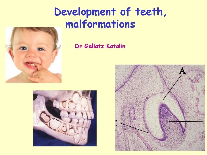 Development of teeth, malformations Dr Gallatz Katalin 
