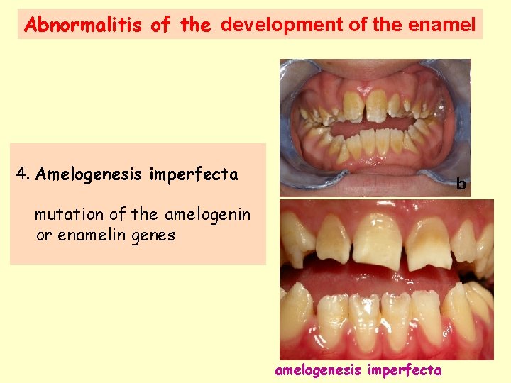 Abnormalitis of the development of the enamel 4. Amelogenesis imperfecta mutation of the amelogenin