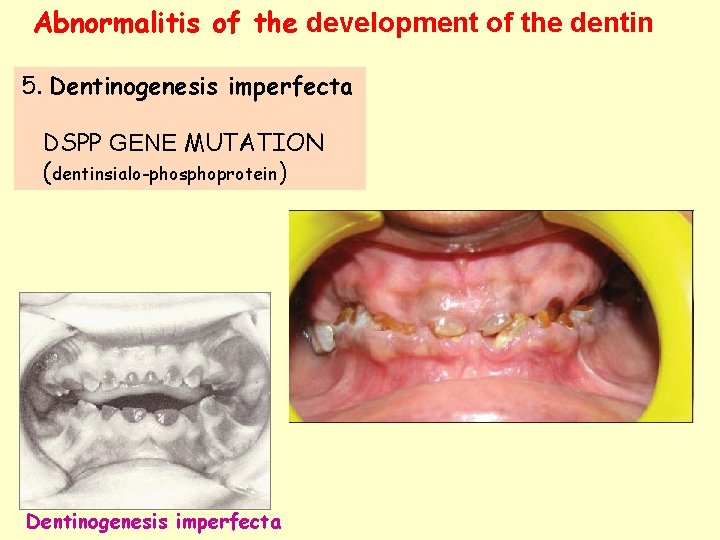 Abnormalitis of the development of the dentin 5. Dentinogenesis imperfecta DSPP GENE MUTATION (dentinsialo-phosphoprotein)