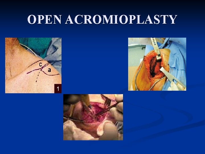 OPEN ACROMIOPLASTY 