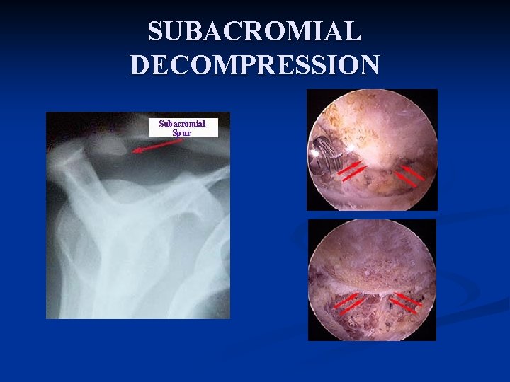 SUBACROMIAL DECOMPRESSION 