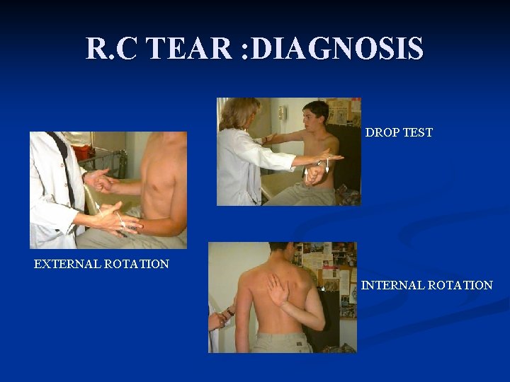 R. C TEAR : DIAGNOSIS DROP TEST EXTERNAL ROTATION INTERNAL ROTATION 