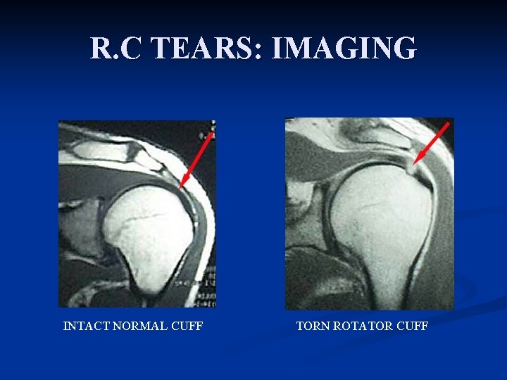 R. C TEARS: IMAGING INTACT NORMAL CUFF TORN ROTATOR CUFF 