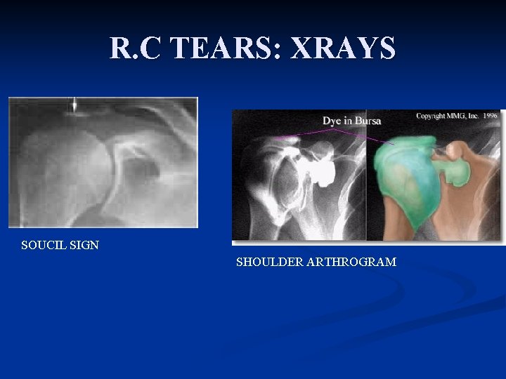 R. C TEARS: XRAYS SOUCIL SIGN SHOULDER ARTHROGRAM 