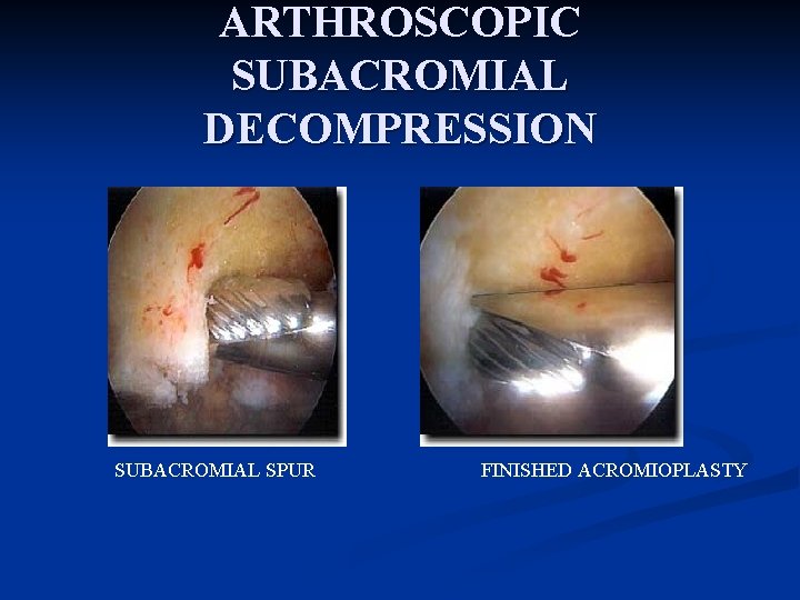 ARTHROSCOPIC SUBACROMIAL DECOMPRESSION SUBACROMIAL SPUR FINISHED ACROMIOPLASTY 