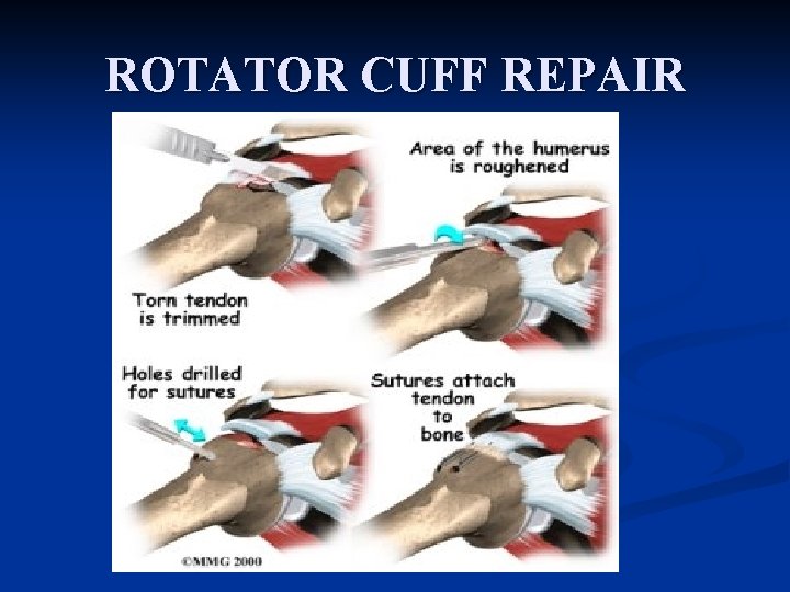 ROTATOR CUFF REPAIR 