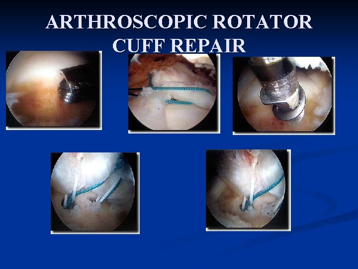 ARTHROSCOPIC ROTATOR CUFF REPAIR 