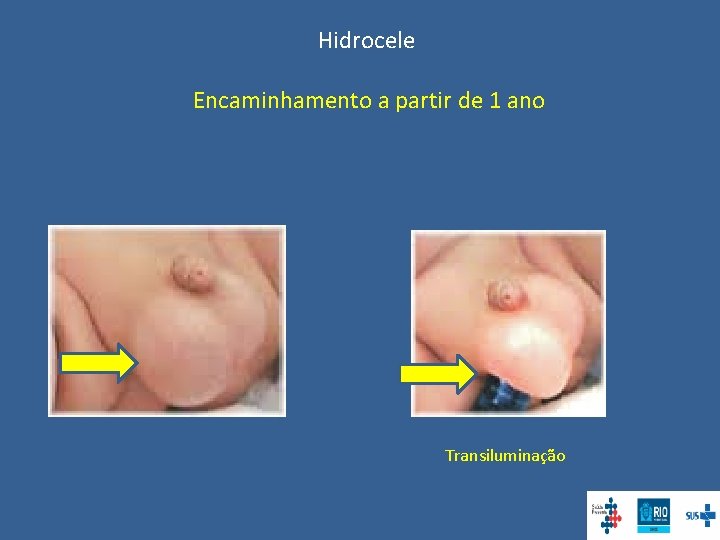 Hidrocele Encaminhamento a partir de 1 ano Transiluminação 