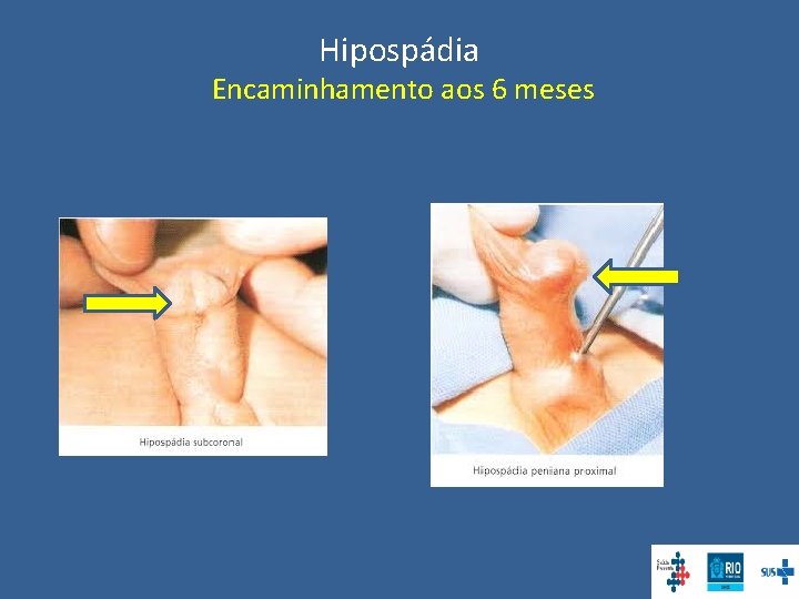 Hipospádia Encaminhamento aos 6 meses 