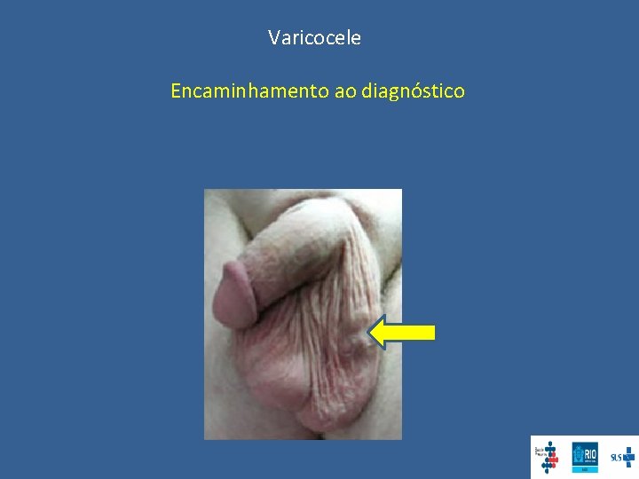 Varicocele Encaminhamento ao diagnóstico 