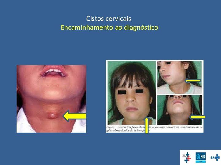 Cistos cervicais Encaminhamento ao diagnóstico 