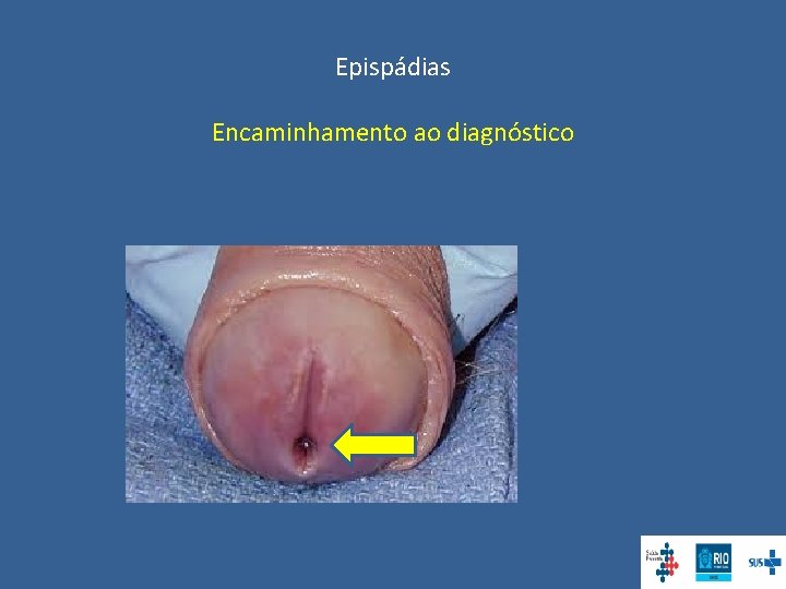 Epispádias Encaminhamento ao diagnóstico 