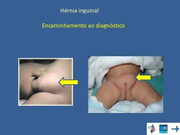 Hérnia inguinal Encaminhamento ao diagnóstico 