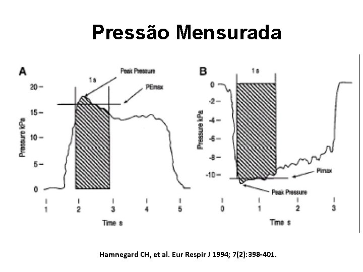 Pressão Mensurada Hamnegard CH, et al. Eur Respir J 1994; 7(2): 398 -401. 