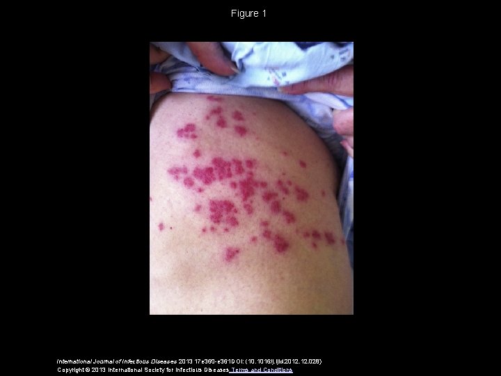 Figure 1 International Journal of Infectious Diseases 2013 17 e 360 -e 361 DOI: