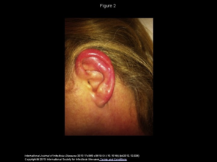 Figure 2 International Journal of Infectious Diseases 2013 17 e 360 -e 361 DOI: