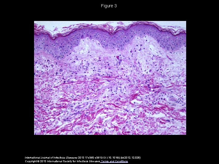 Figure 3 International Journal of Infectious Diseases 2013 17 e 360 -e 361 DOI: