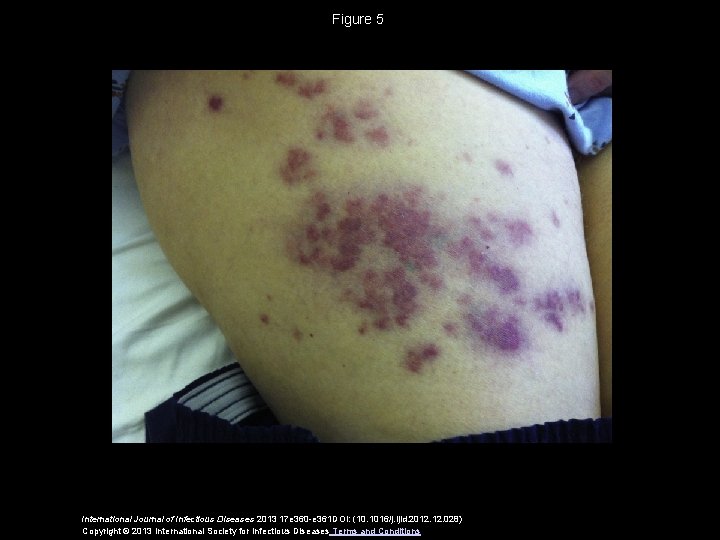 Figure 5 International Journal of Infectious Diseases 2013 17 e 360 -e 361 DOI: