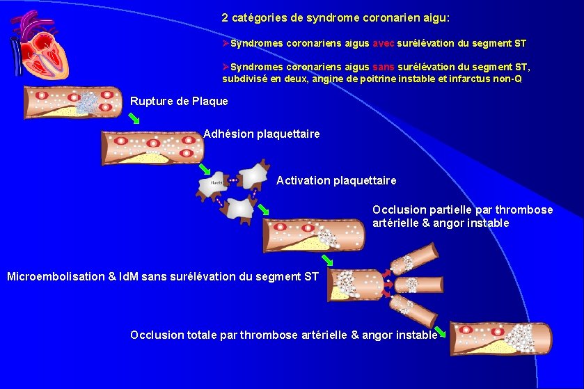 2 catégories de syndrome coronarien aigu: ØSyndromes coronariens aigus avec surélévation du segment ST 2 catégories de syndrome coronarien aigu: ØSyndromes coronariens aigus avec surélévation du segment ST