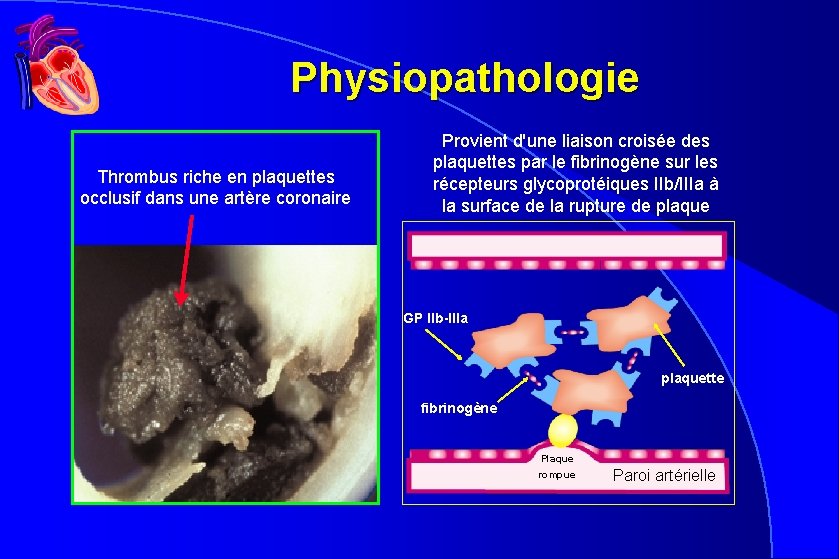 Physiopathologie Thrombus riche en plaquettes occlusif dans une artère coronaire Provient d'une liaison croisée Physiopathologie Thrombus riche en plaquettes occlusif dans une artère coronaire Provient d'une liaison croisée