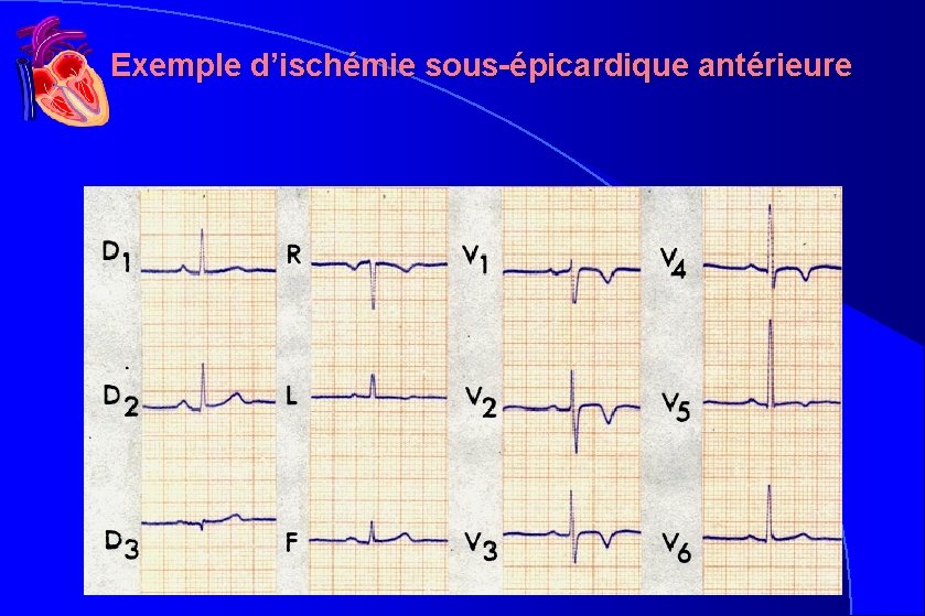 Exemple d’ischémie sous-épicardique antérieure Exemple d’ischémie sous-épicardique antérieure