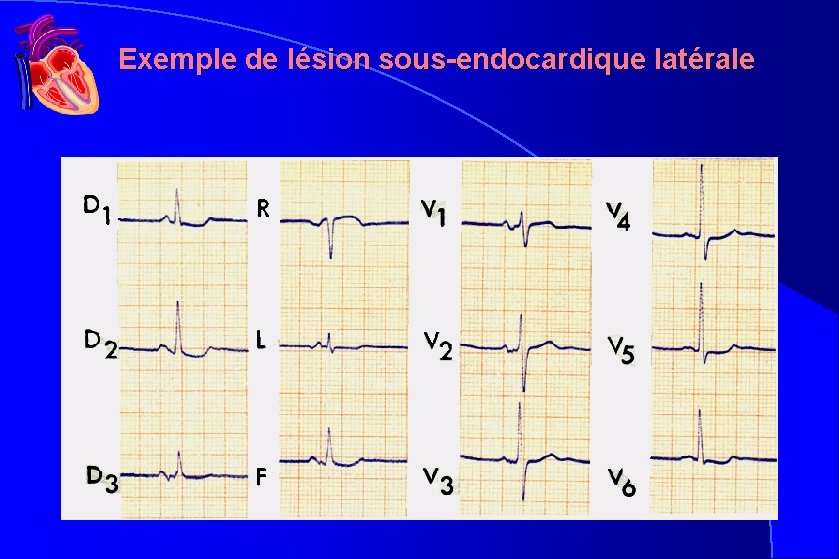 Exemple de lésion sous-endocardique latérale Exemple de lésion sous-endocardique latérale