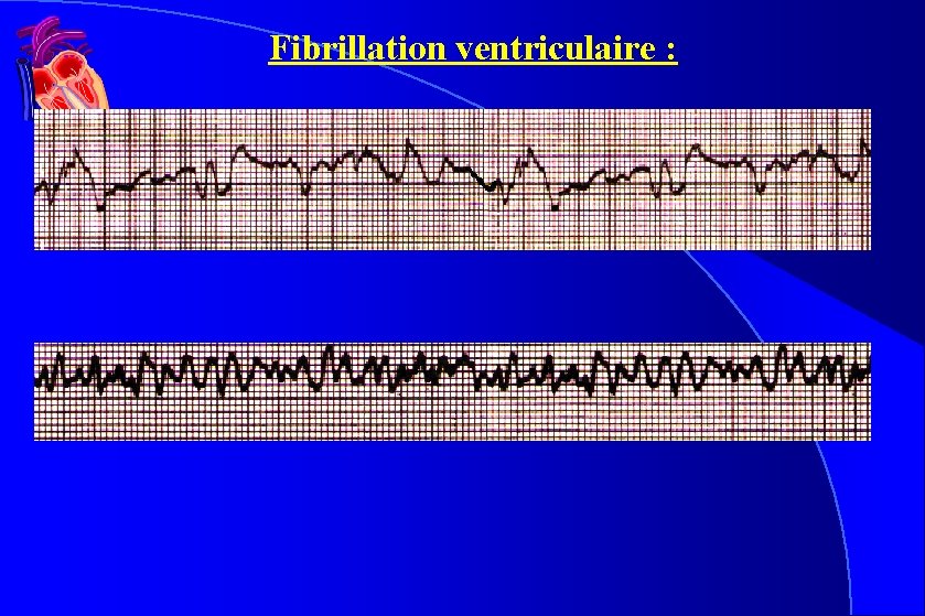 Fibrillation ventriculaire : Fibrillation ventriculaire :