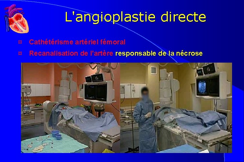 L'angioplastie directe ¤ Cathétérisme artériel fémoral ¤ Recanalisation de l'artère responsable de la nécrose L'angioplastie directe ¤ Cathétérisme artériel fémoral ¤ Recanalisation de l'artère responsable de la nécrose