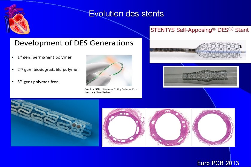 Evolution des stents Euro PCR 2013 Evolution des stents Euro PCR 2013