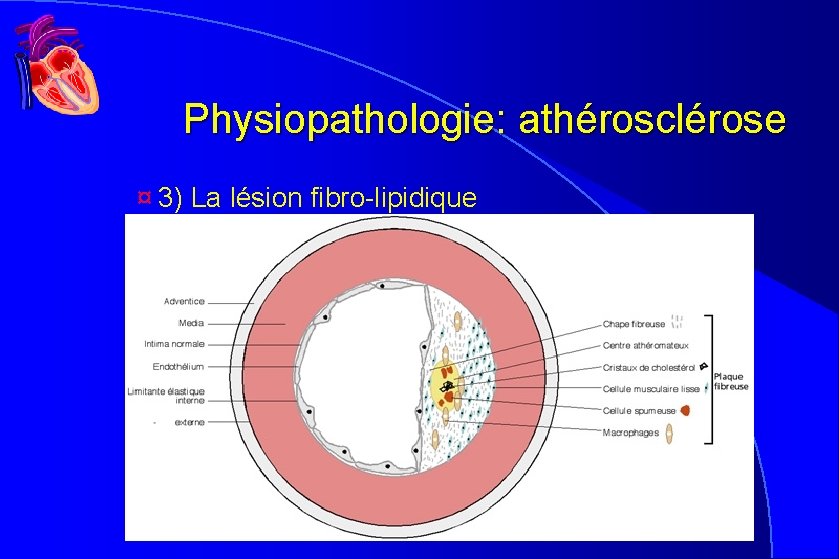 Physiopathologie: athérosclérose ¤ 3) La lésion fibro-lipidique Physiopathologie: athérosclérose ¤ 3) La lésion fibro-lipidique