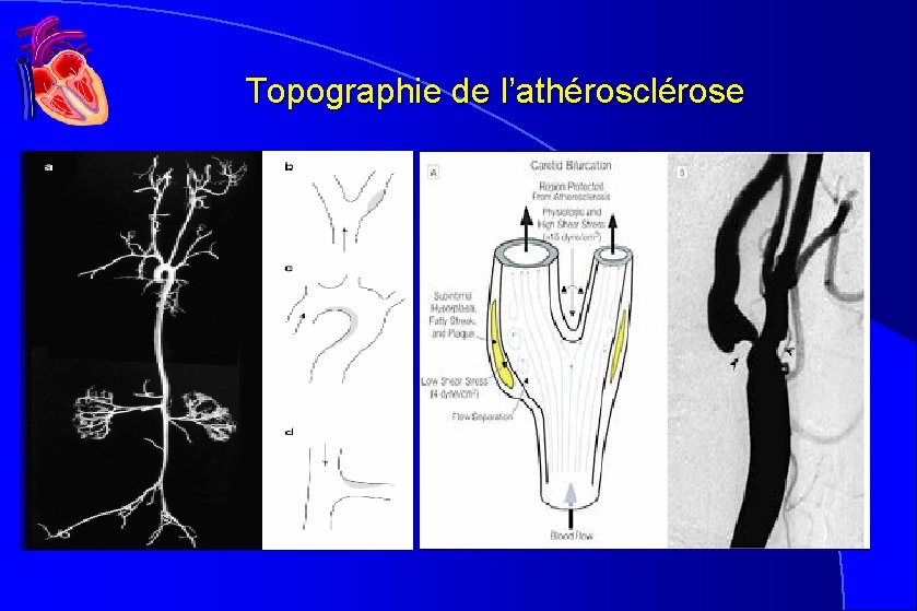 Topographie de l’athérosclérose Topographie de l’athérosclérose