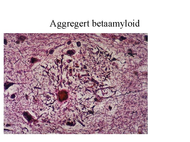 Aggregert betaamyloid Aggregert betaamyloid