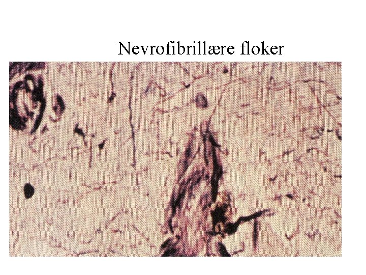 Nevrofibrillære floker Nevrofibrillære floker