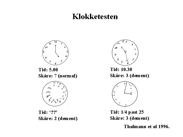 Klokketesten Tid: 5. 00 Skåre: 7 (normal) Tid: 10. 30 Skåre: 3 (dement) Tid: Klokketesten Tid: 5. 00 Skåre: 7 (normal) Tid: 10. 30 Skåre: 3 (dement) Tid: