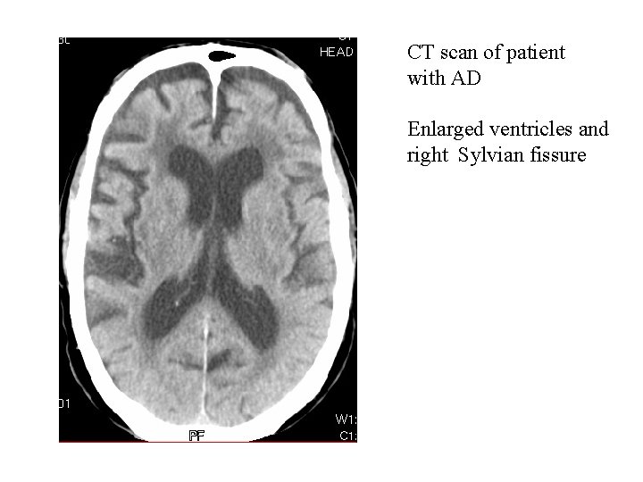 CT scan of patient with AD Enlarged ventricles and right Sylvian fissure CT scan of patient with AD Enlarged ventricles and right Sylvian fissure