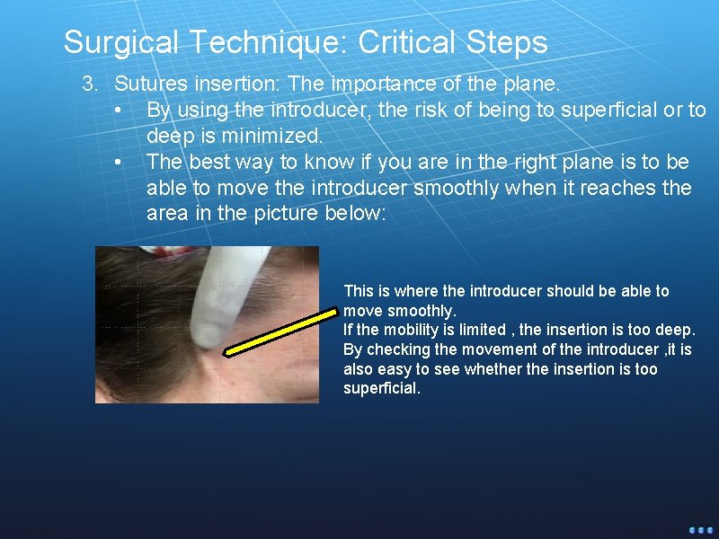 Surgical Technique: Critical Steps 3. Sutures insertion: The importance of the plane. • By