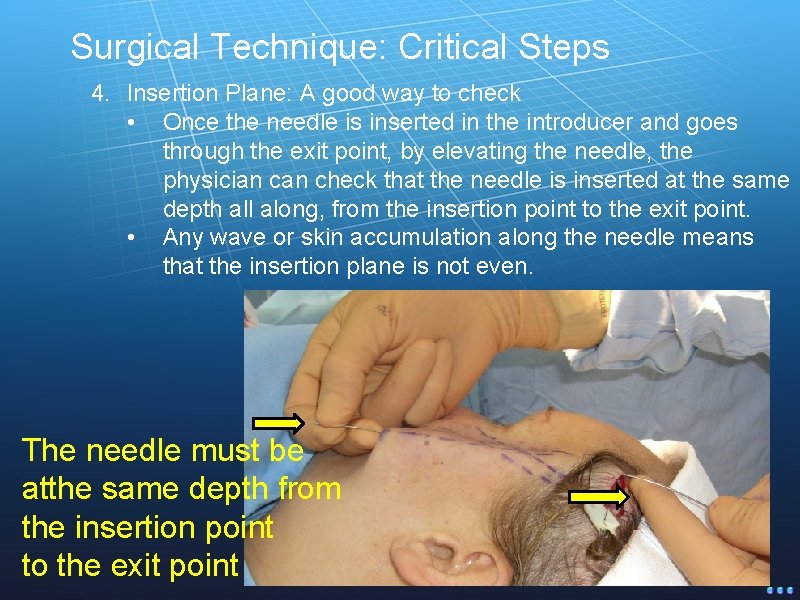Surgical Technique: Critical Steps 4. Insertion Plane: A good way to check • Once