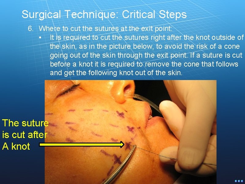 Surgical Technique: Critical Steps 6. Where to cut the sutures at the exit point: