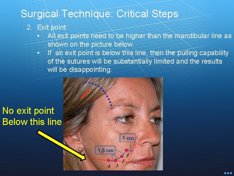 Surgical Technique: Critical Steps 2. Exit point: • All exit points need to be