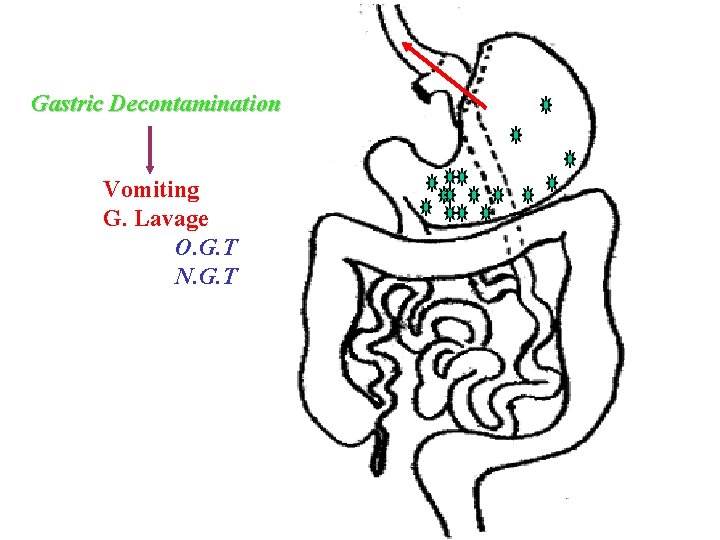 Gastric Decontamination Vomiting G. Lavage O. G. T N. G. T 