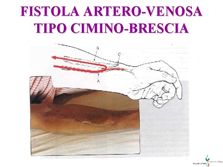 FISTOLA ARTERO-VENOSA TIPO CIMINO-BRESCIA 