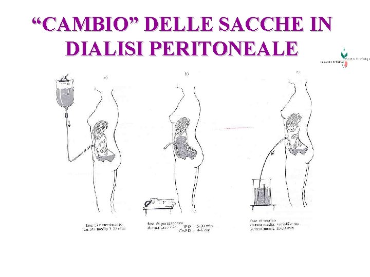 “CAMBIO” DELLE SACCHE IN DIALISI PERITONEALE 