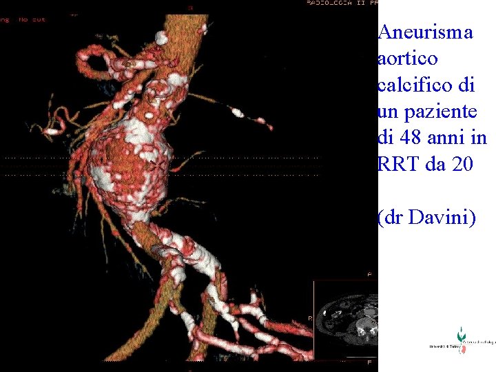 Aneurisma aortico calcifico di un paziente di 48 anni in RRT da 20 (dr
