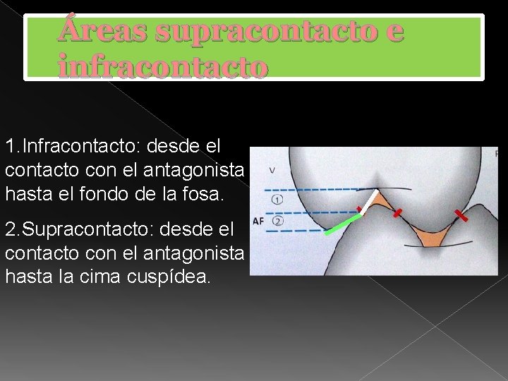 Áreas supracontacto e infracontacto 1. Infracontacto: desde el contacto con el antagonista hasta el