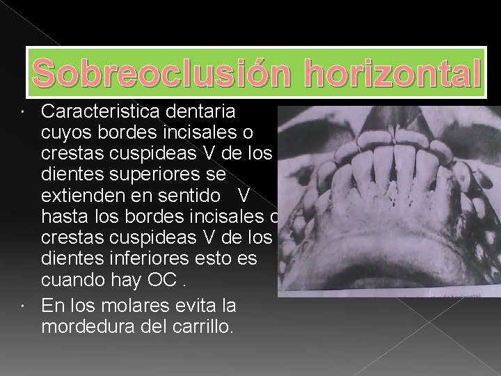 Sobreoclusión horizontal Caracteristica dentaria cuyos bordes incisales o crestas cuspideas V de los dientes
