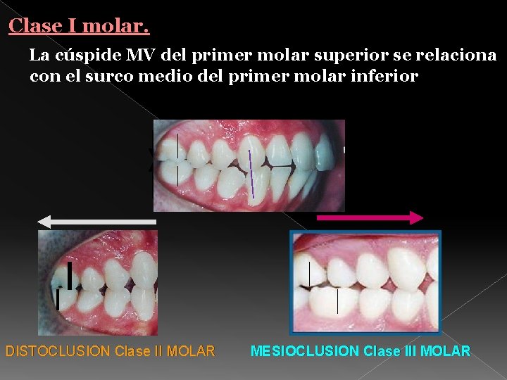 Clase I molar. La cúspide MV del primer molar superior se relaciona con el