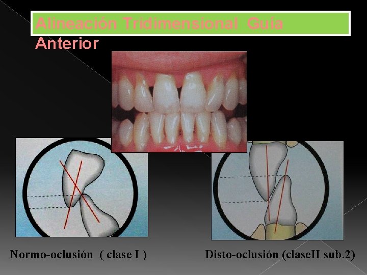 Alineación Tridimensional Guía Anterior Normo-oclusión ( clase I ) Disto-oclusión (clase. II sub. 2)